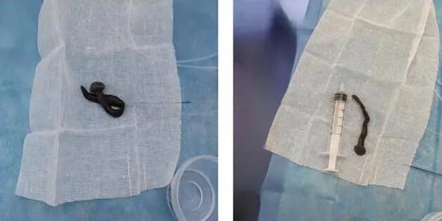 女子咳嗽半月氣管發(fā)現(xiàn)8cm螞蟥